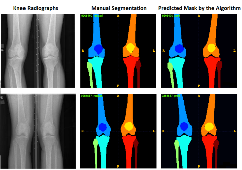 Acquiring Impartial Image Segmentation Skills: An In-depth Analysis Using Plain Knee Radiographs as a Case Study