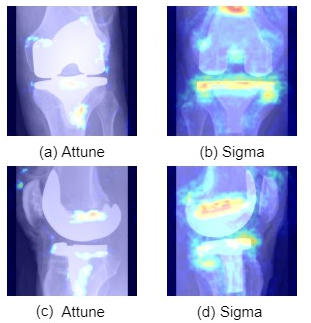 DeepTKAClassifier: Brand Classification of Total Knee Arthroplasty Implants using Explainable Deep Convolutional Neural Networks